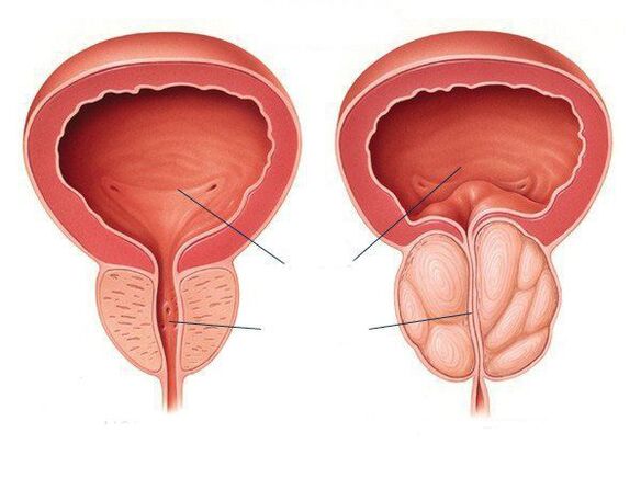 нормално възпаление на простатата и простатата