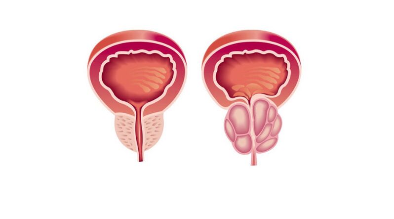 сравнение на нормална и болна простата